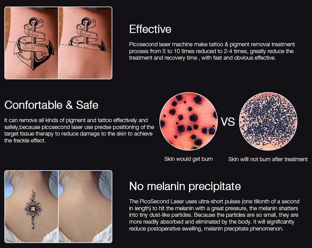 Kalsten | Instant Laser Dark Spot & Tattoo Remover