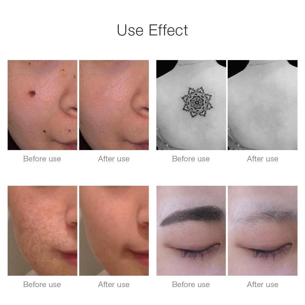 Kalsten | Instant Laser Dark Spot & Tattoo Remover
