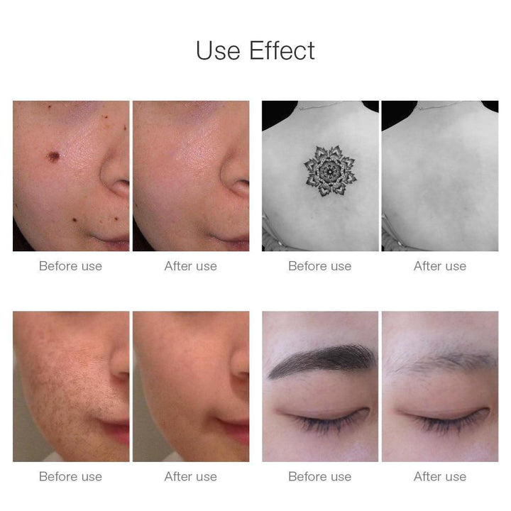 Kalsten | Instant Laser Dark Spot & Tattoo Remover