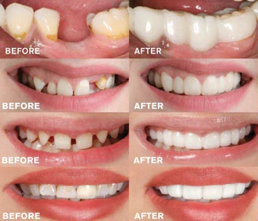 Kalsten |  - Snap-in Dental Prosthesis | 1+1 FREE!