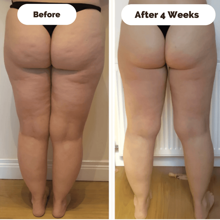 Kalsten | DERMAGLOW – Skin-Firming Massage Device for Cellulite