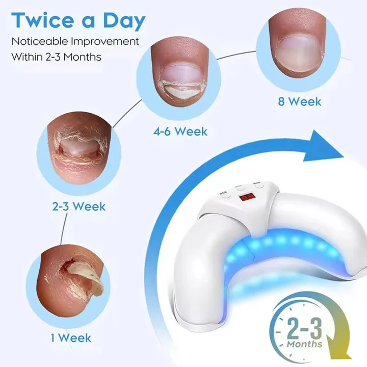 Kalsten | Nail Fungus Laser