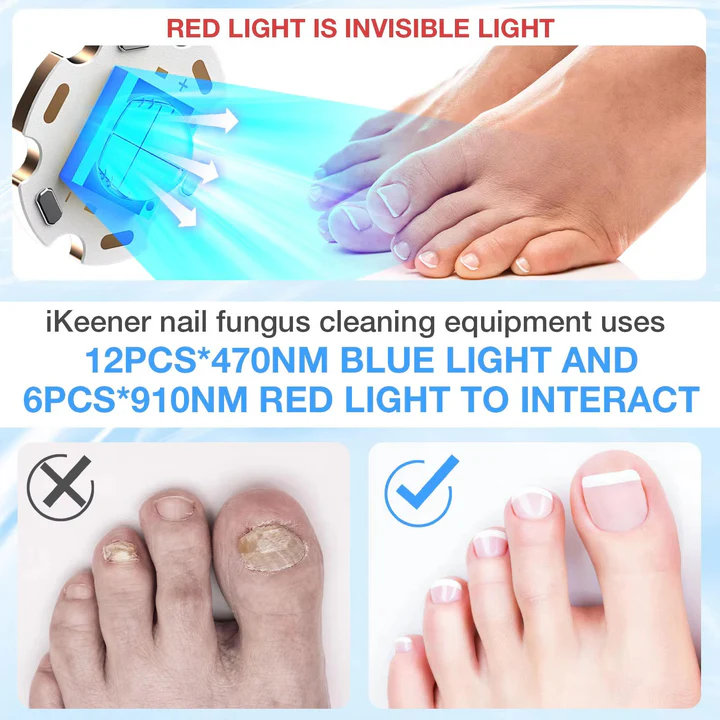 Kalsten | Nail Fungus Laser