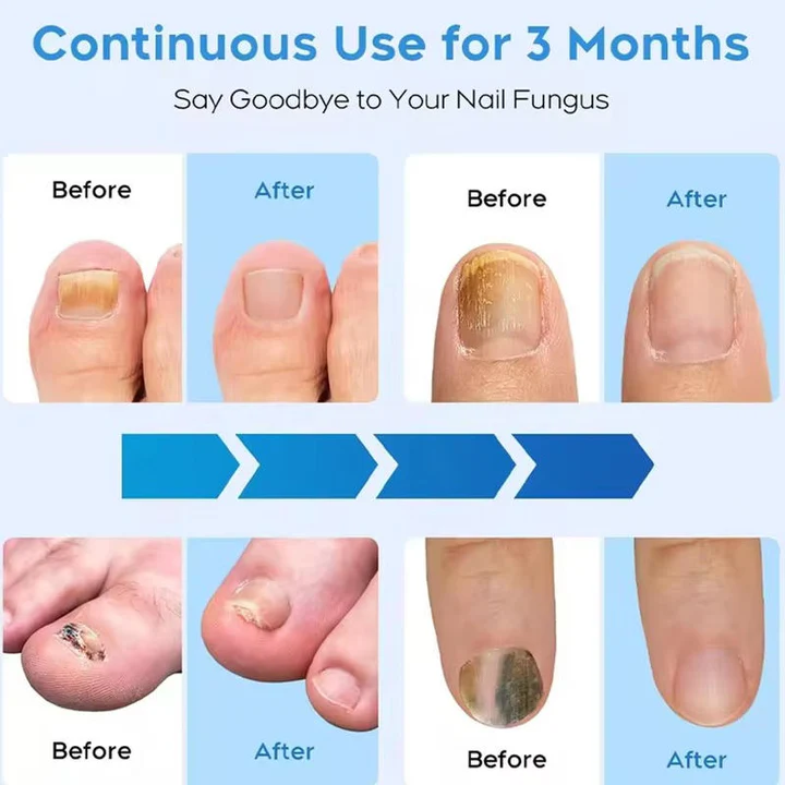 Kalsten | Nail Fungus Laser