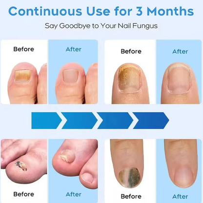 Skanto | Nail Fungus Laser