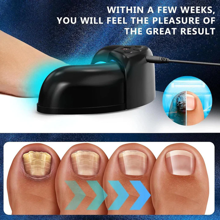 Kalsten | Nail Fungus Laser