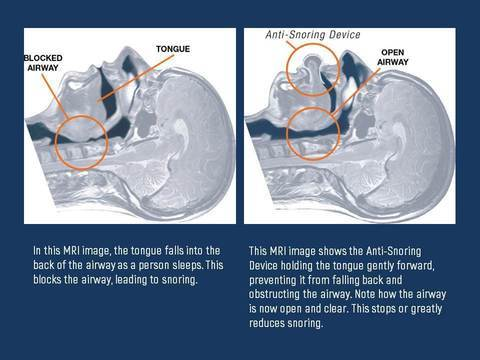 Kalsten | Apnea Tongue Stabilizing Device