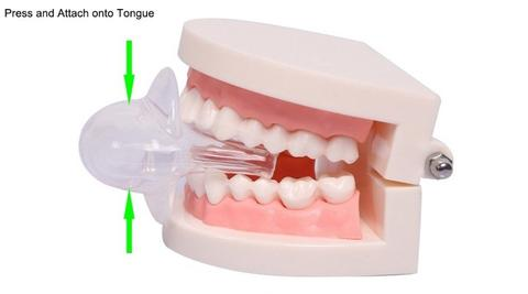 Kalsten | Apnea Tongue Stabilizing Device