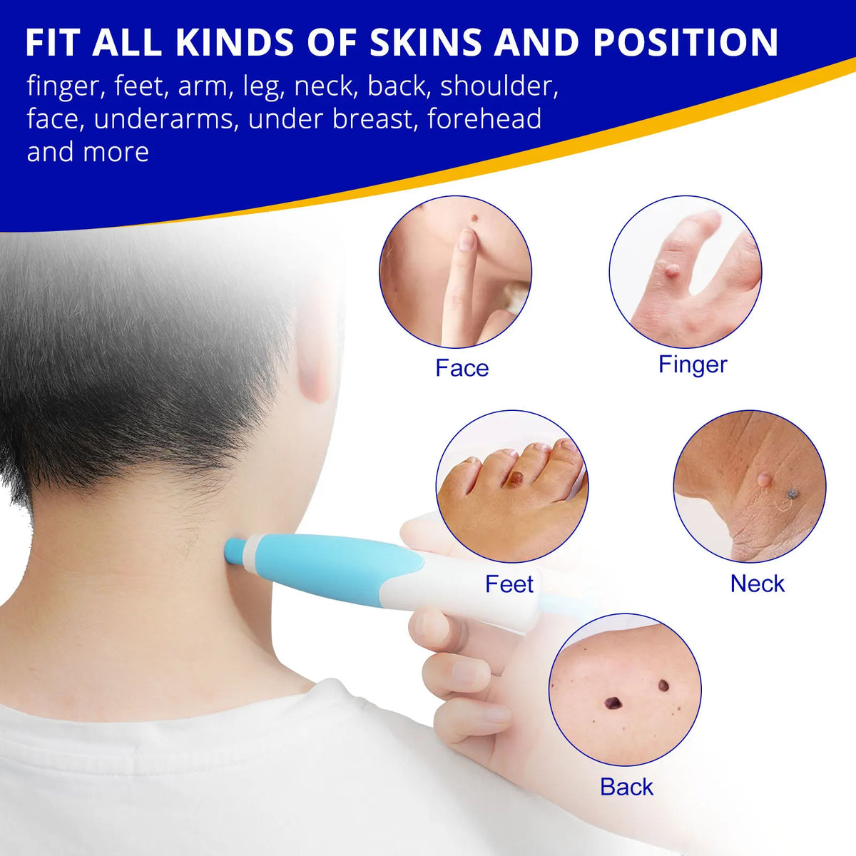 Skin Tag Remover Kit | Non-invasive & Effective | Karnz