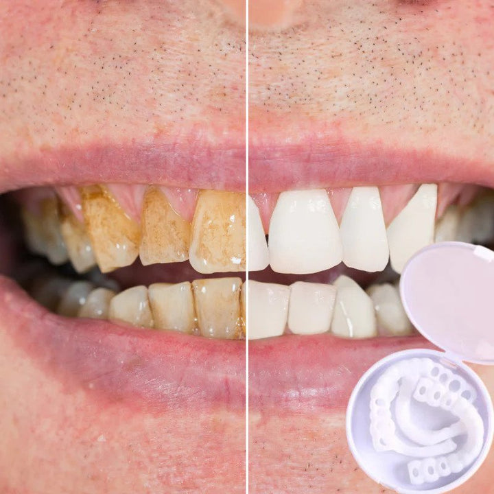 Kalsten | Snap-on Teeth™ - With these veneers, always have the perfect smile