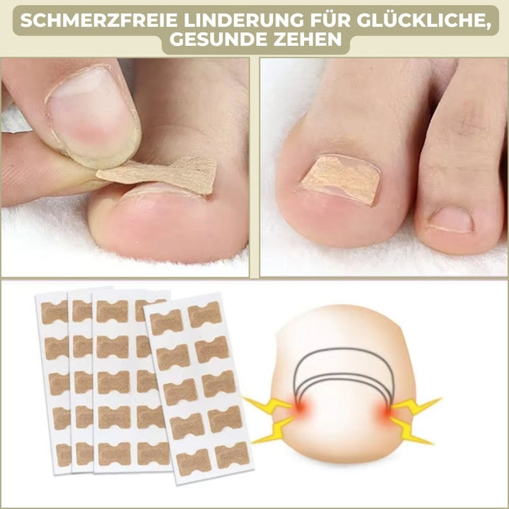 Kalsten | ALIGNSTRIP – Painless Nail Correction Strips for Ingrown & Deformed Nails