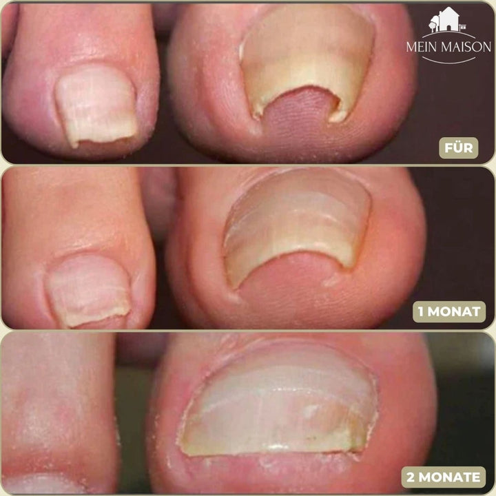 ALIGNSTRIP Painless Ingrown Nail Correction Strips
