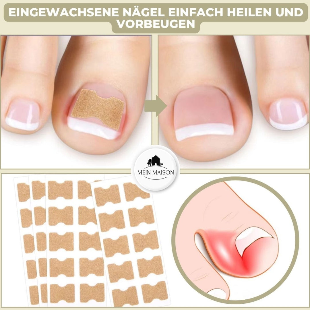ALIGNSTRIP Painless Ingrown Nail Correction Strips