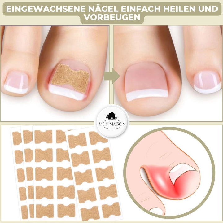 ALIGNSTRIP Painless Ingrown Nail Correction Strips
