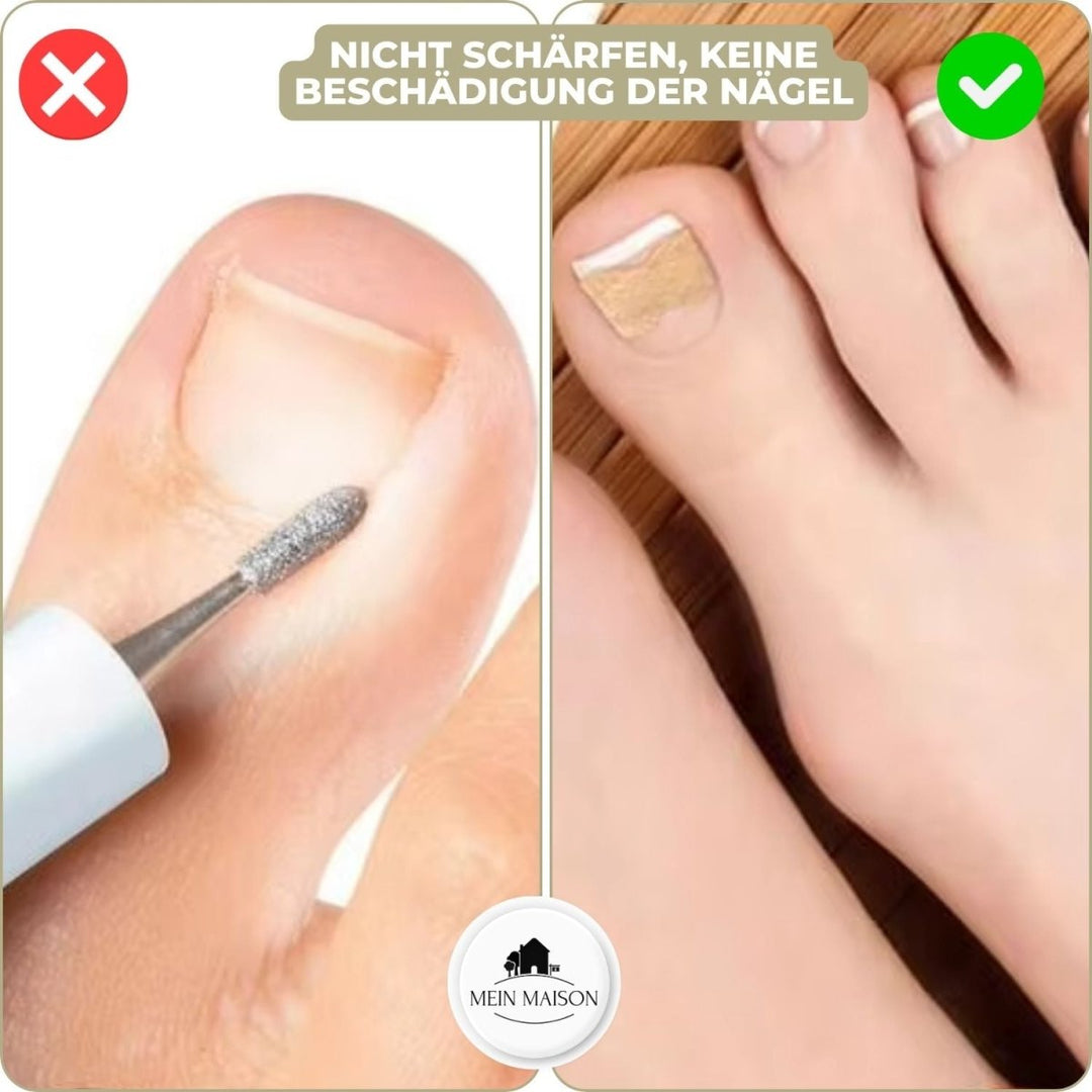 Kalsten | ALIGNSTRIP – Painless Nail Correction Strips for Ingrown & Deformed Nails