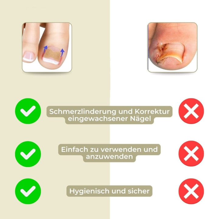 ALIGNSTRIP Painless Ingrown Nail Correction Strips