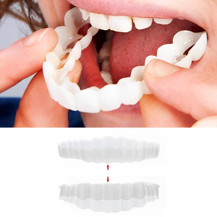 Kalsten | Removable Smile Veneers for Upper and Lower Teeth