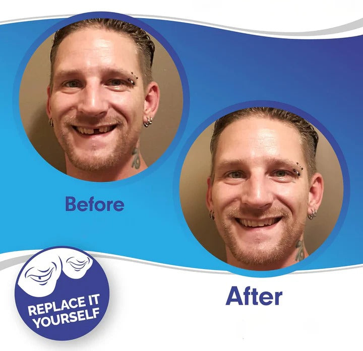 Kalsten | Removable Smile Veneers for Upper and Lower Teeth