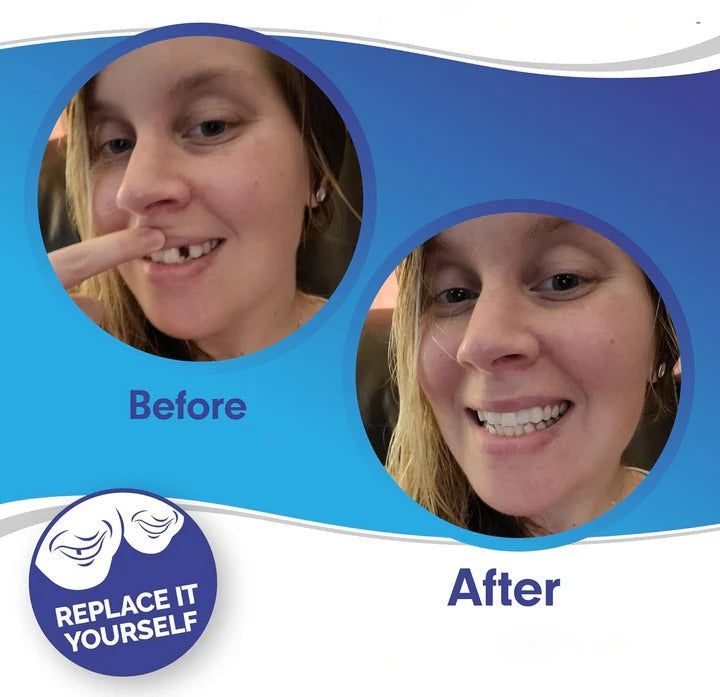 Kalsten | Removable Smile Veneers for Upper and Lower Teeth