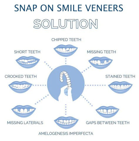 Kalsten | Removable Smile Veneers for Upper and Lower Teeth