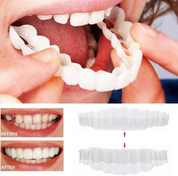 Kalsten | Removable Smile Veneers for Upper and Lower Teeth